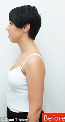 Stem Cells Breast Enhancement Before Picture